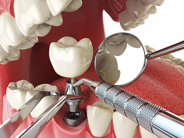 Best Emergency Tooth Extraction in Cedar Mill, OR